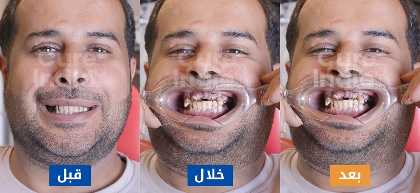 تلبيس الأسنان قبل وبعد الصور